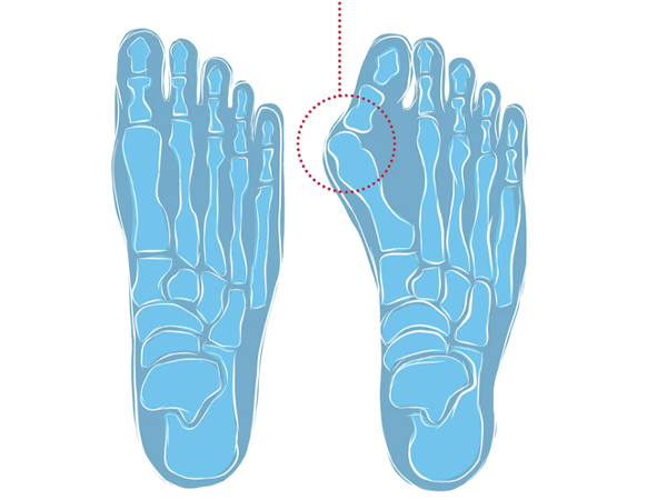 Wat is een hallux valgus?