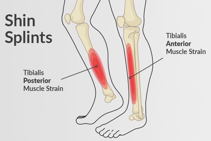 Hoe ontstaan shin splints?