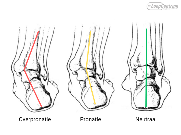 Overpronatie